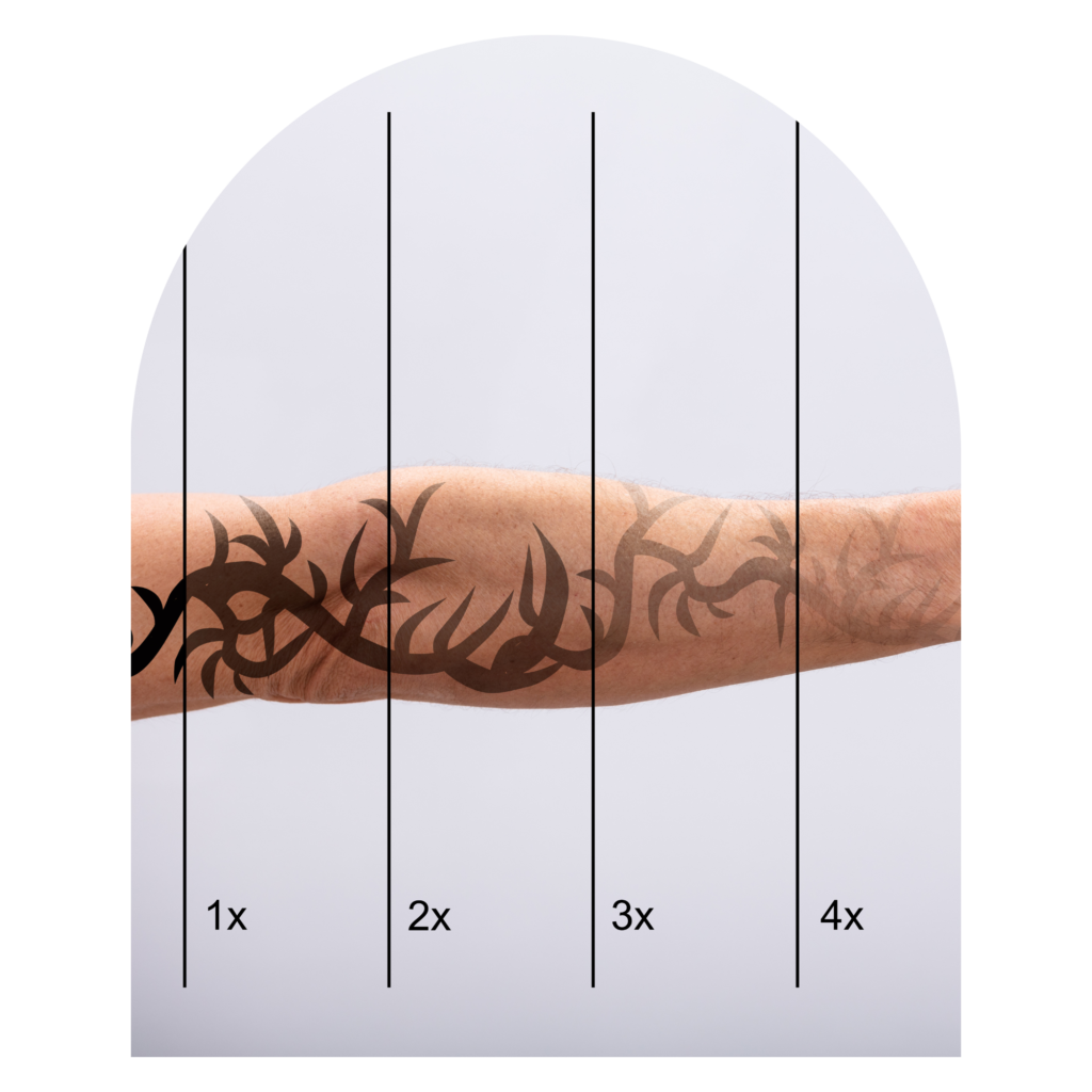 Tattooentfernung Berlin