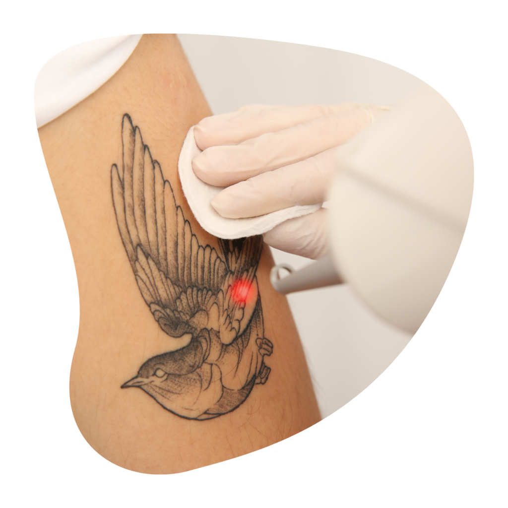 Tattooentfernung Preise Berlin